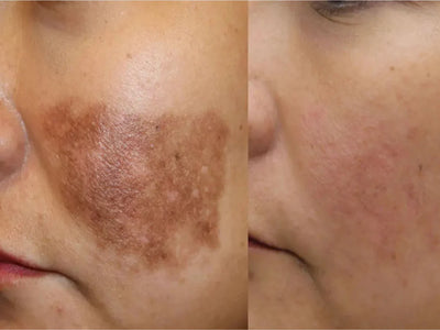 Pigmentation