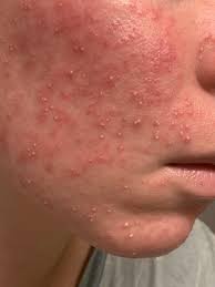 Skin Barrier