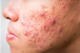 Acne Prone Skin