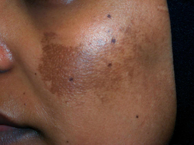 Melasma