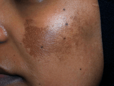 Melasma