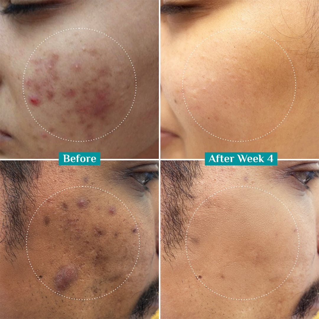 La Roche‑Posay Niacinamide B5 Serum (10%)