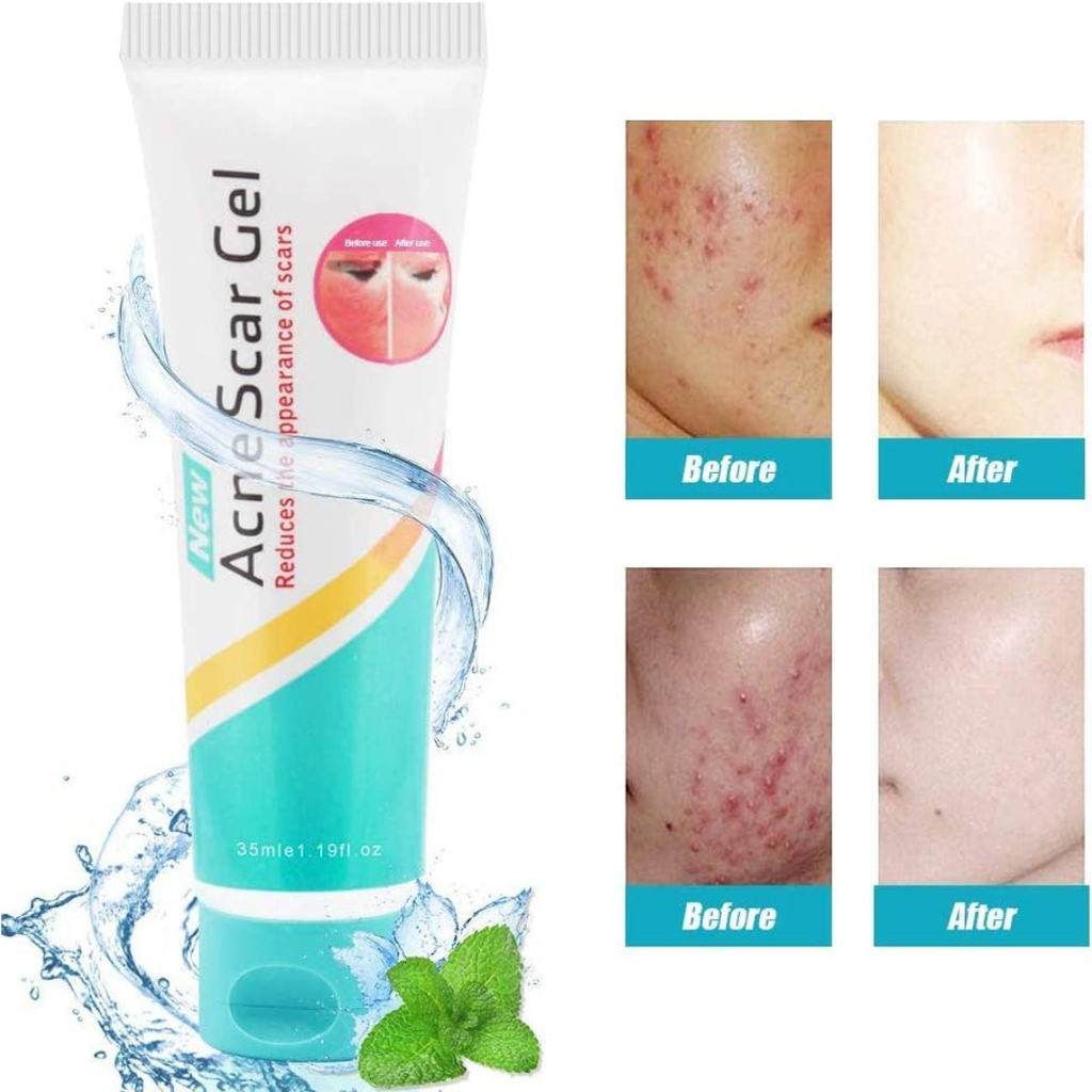 Acne Scar Gel