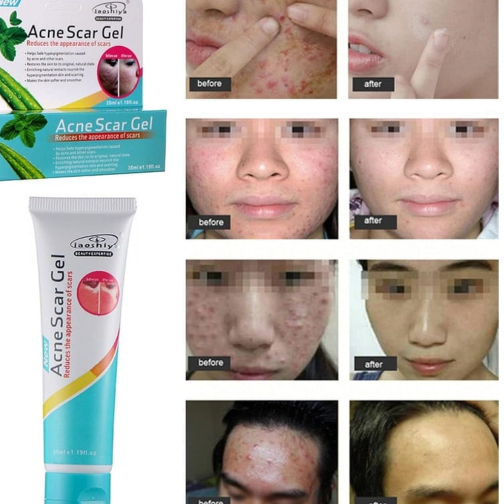 Acne Scar Gel