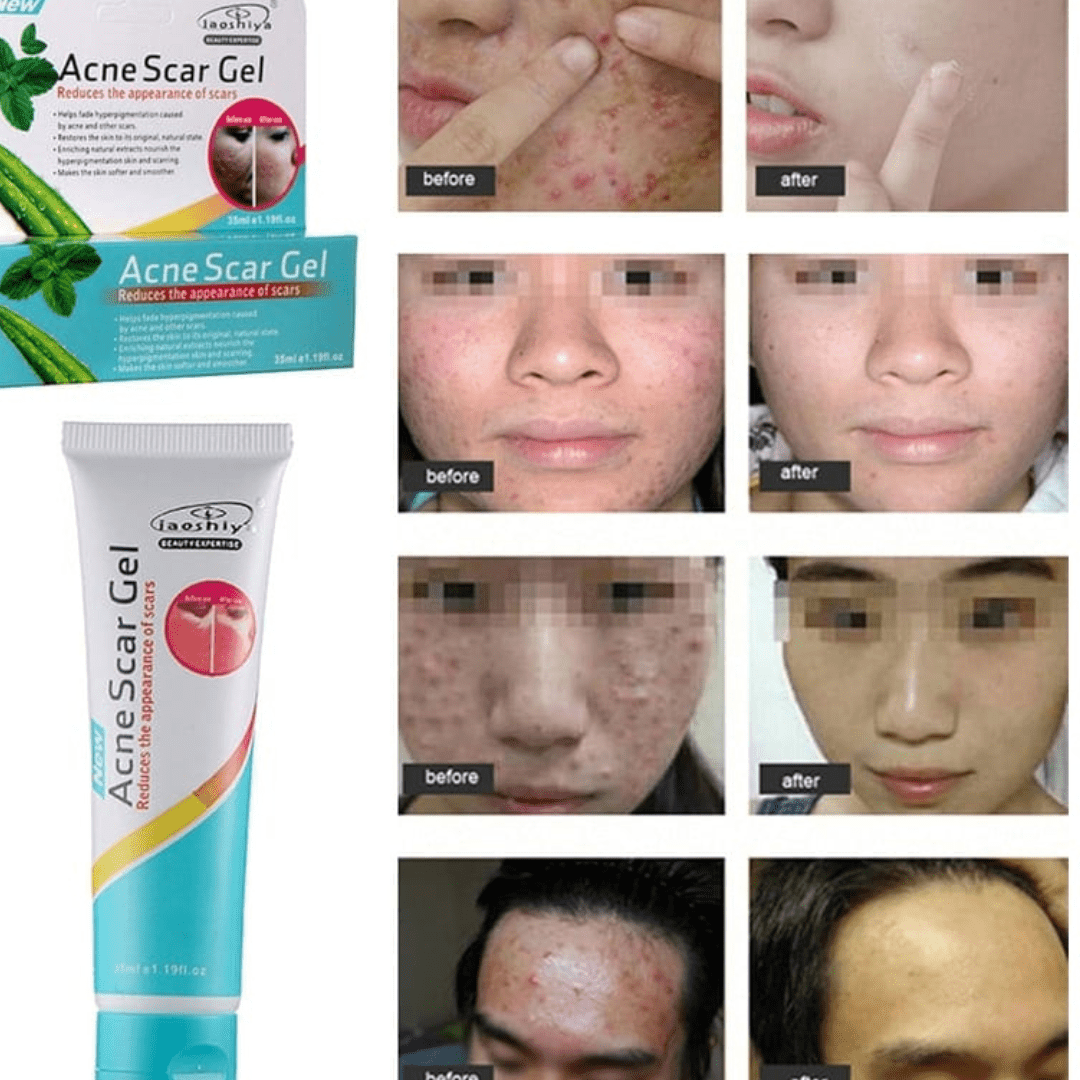Acne Scar Gel - Cosmera.store