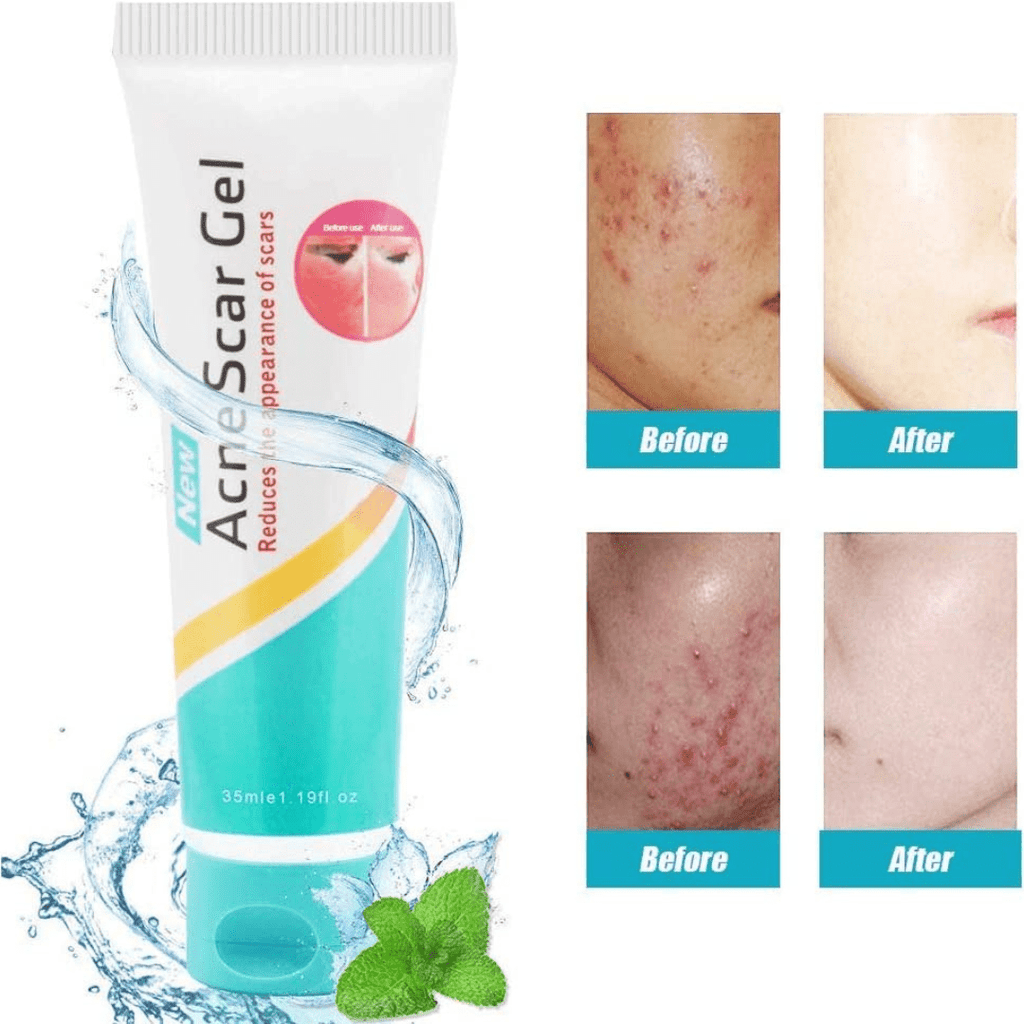 Acne Scar Gel - Cosmera.store